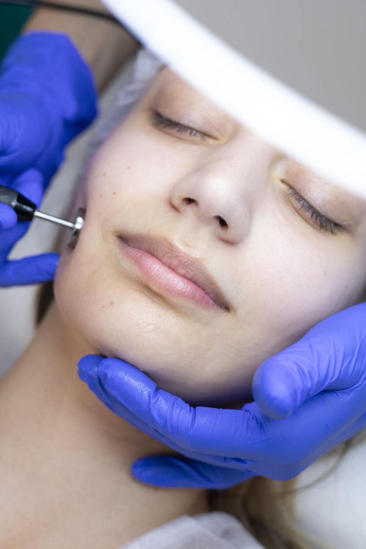 Ριζική Αποτρίχωση Apilus Center - Miss Skin